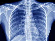 chest x-ray lindsay kawartha lake